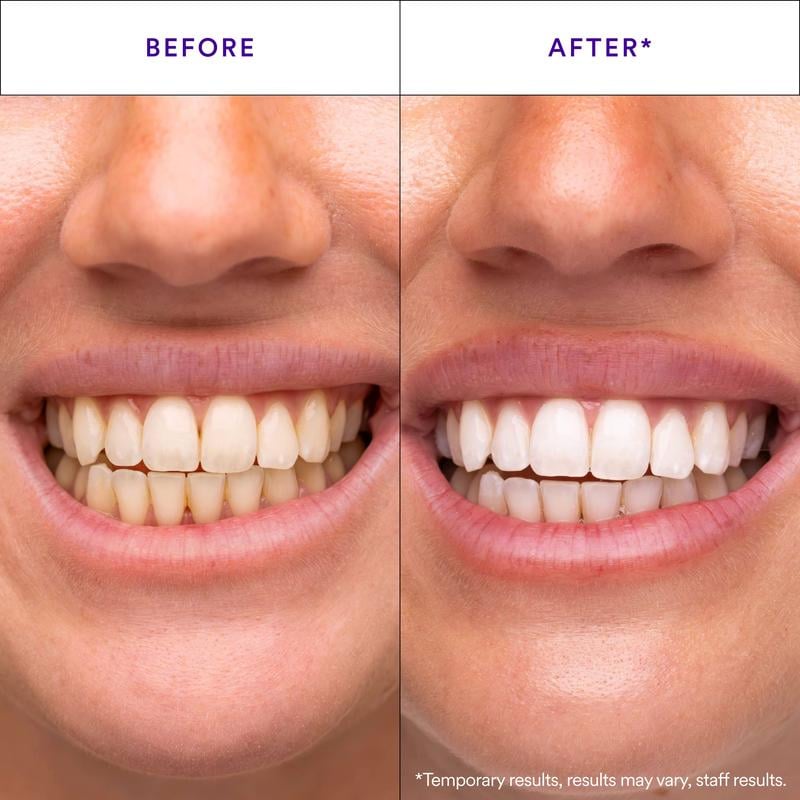 Purple Tooth Whitening