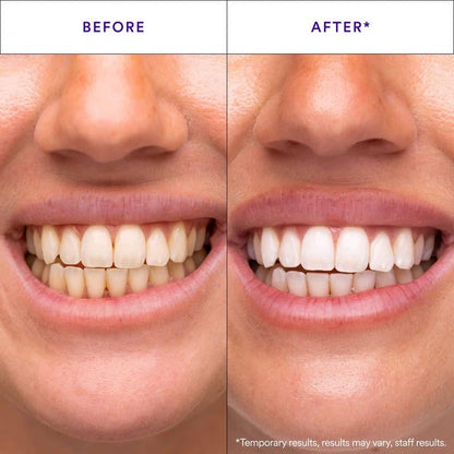 Purple Tooth Whitening